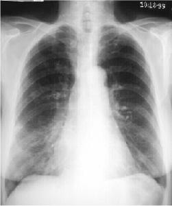Hình ảnh chụp X-Quang viêm phổi phân biệt các dạng bệnh 9