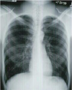 X-Quang viêm phổi