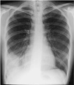 Hình ảnh chụp X-Quang viêm phổi phân biệt các dạng bệnh 28