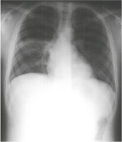 Hình ảnh chụp X-Quang viêm phổi phân biệt các dạng bệnh 30