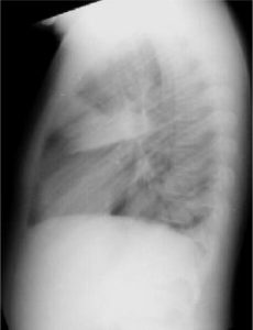 Hình ảnh chụp X-Quang viêm phổi phân biệt các dạng bệnh 31
