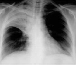Hình ảnh chụp X-Quang viêm phổi phân biệt các dạng bệnh 34