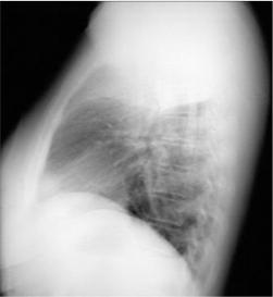 Hình ảnh chụp X-Quang viêm phổi phân biệt các dạng bệnh 35