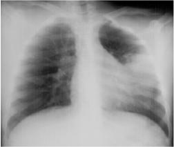 Hình ảnh chụp X-Quang viêm phổi phân biệt các dạng bệnh 36