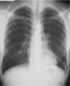 Hình ảnh chụp X-Quang viêm phổi phân biệt các dạng bệnh 37