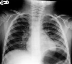 Hình ảnh chụp X-Quang viêm phổi phân biệt các dạng bệnh 41