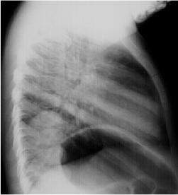 Hình ảnh chụp X-Quang viêm phổi phân biệt các dạng bệnh 42