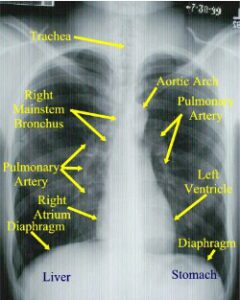 X-Quang viêm phổi