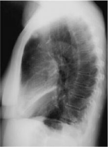 Hình ảnh chụp X-Quang viêm phổi phân biệt các dạng bệnh 23