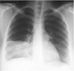 Hình ảnh chụp X-Quang viêm phổi phân biệt các dạng bệnh 24