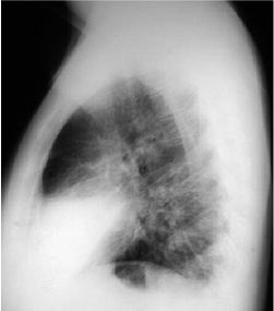 Hình ảnh chụp X-Quang viêm phổi phân biệt các dạng bệnh 25