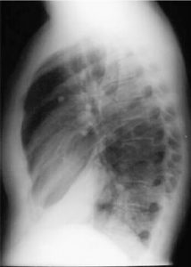Hình ảnh chụp X-Quang viêm phổi phân biệt các dạng bệnh 27