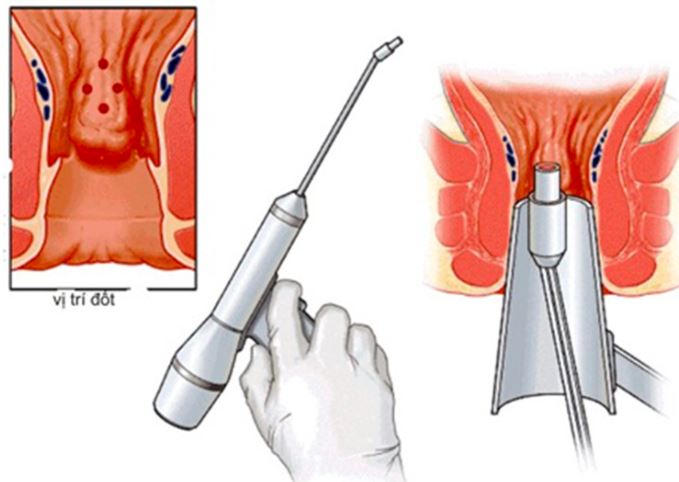 Phẫu thuật cắt trĩ bằng phương pháp HCPT