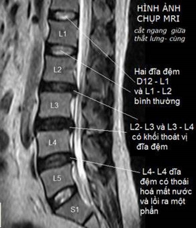 MRI thắt lưng