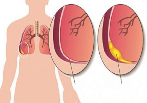 Viêm phế quản phổi ở trẻ: Cách điều trị hiệu quả nhất 3