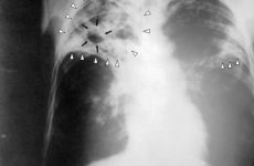 Bệnh án lao phổi AFB dương tính