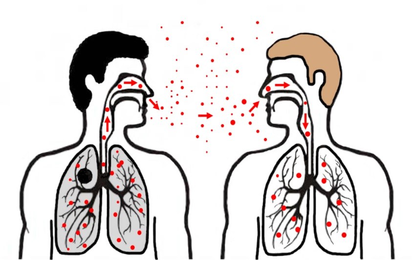 Bệnh phổi có nước có lây không?
