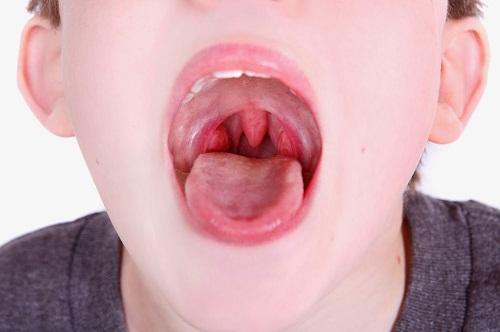 cách điều trị viêm họng hạt ở trẻ em