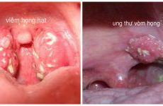 phân biệt viêm họng hạt và ung thư vòm họng