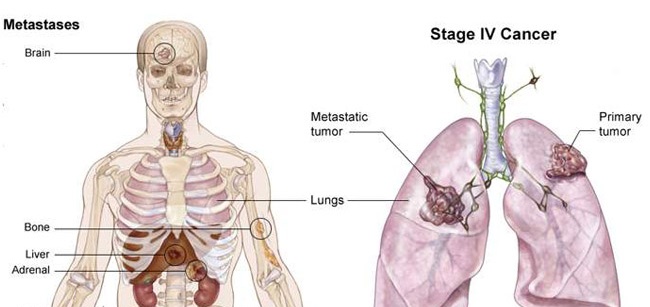 Ung thư phổi giai đoạn 4
