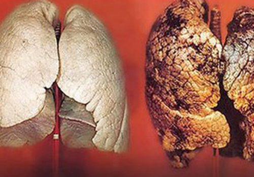 ung thư phổi 1,2,3,4