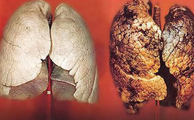 Ung thư phổi sống được bao lâu?