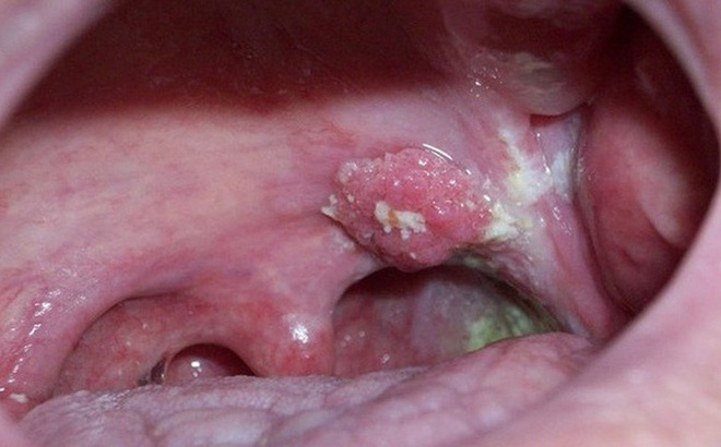 viêm amidan có dẫn đến ung thư vòm họng