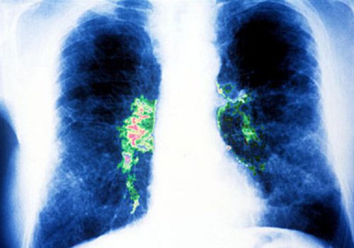 Phác đồ điều trị viêm phổi