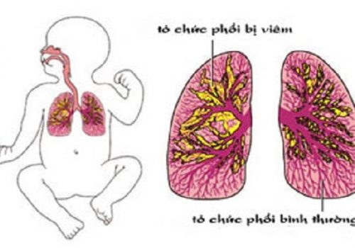 Viêm phổi ở trẻ sơ sinh